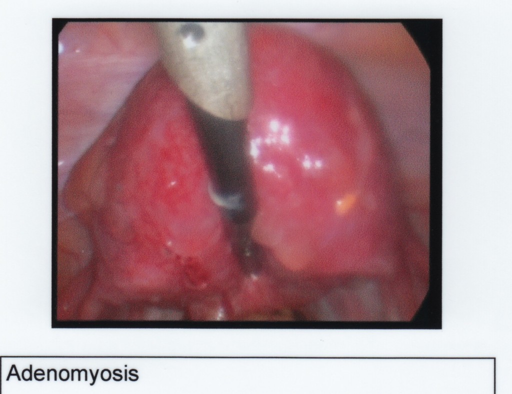 Adenomyosis in the uterus wall, photo taken during laparoscopy for endometriosis